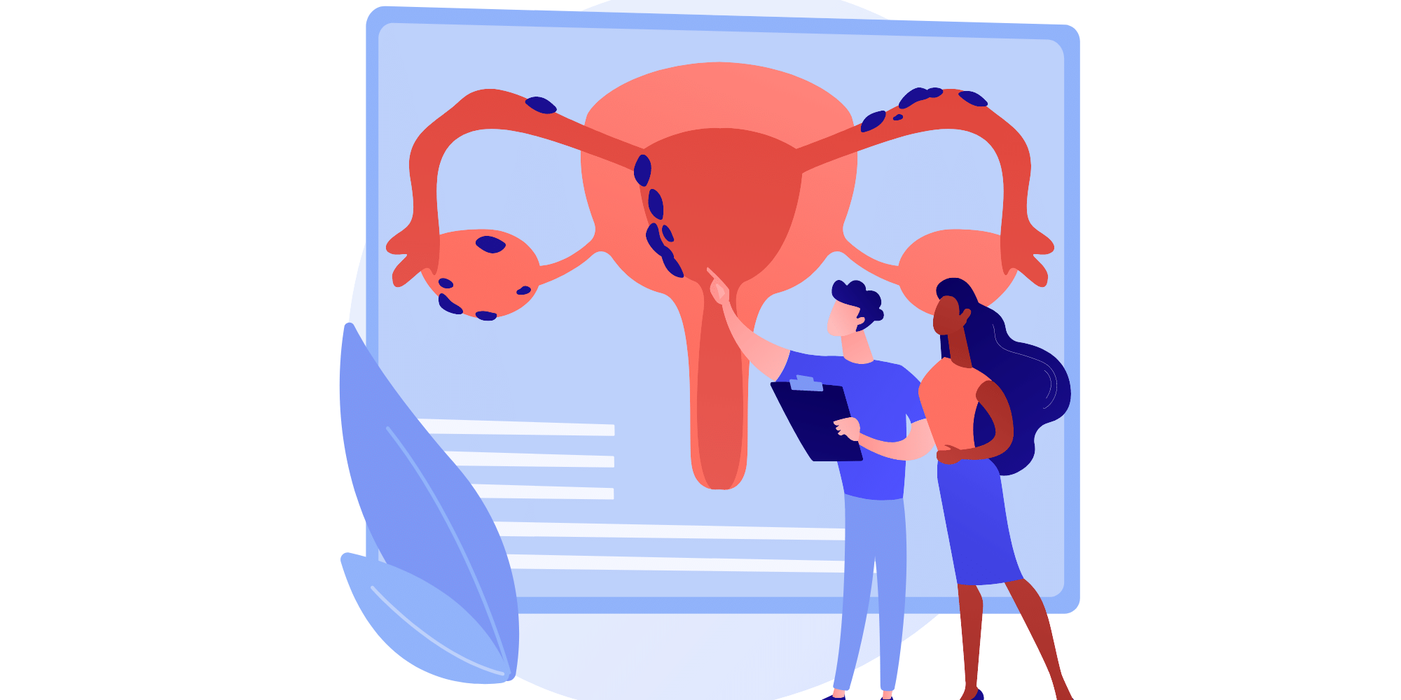 illustration représentant l'utérus d'une femme atteint d'endométrioses